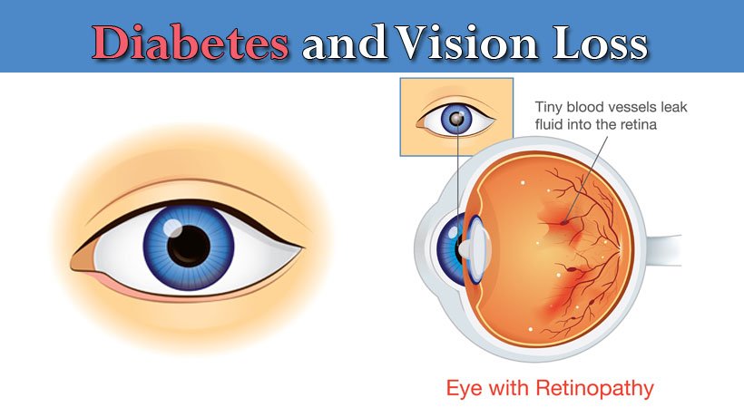 4 Serious Eye Conditions Caused by Diabetes That Can Lead to Vision ...