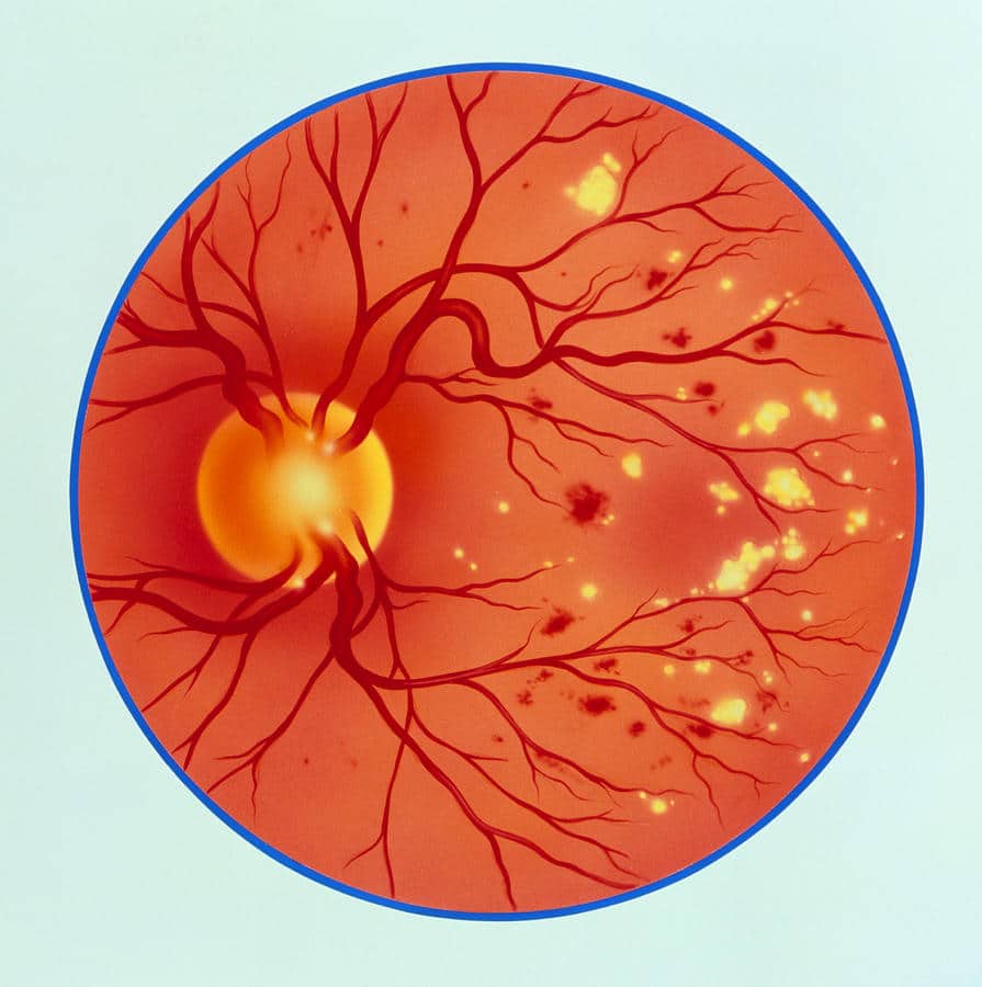 Artwork Of Diabetic Retinopathy Ophthalmoscope View Photograph by John ...