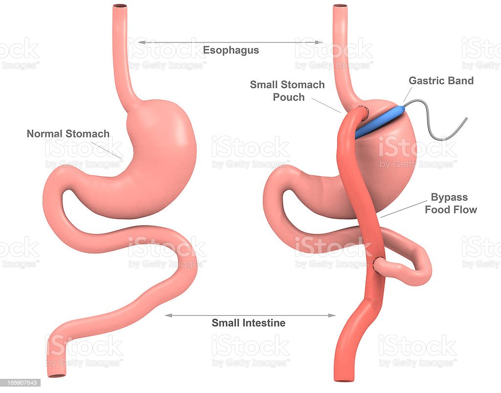 Band Gastric Bypass Surgery Stock Photo