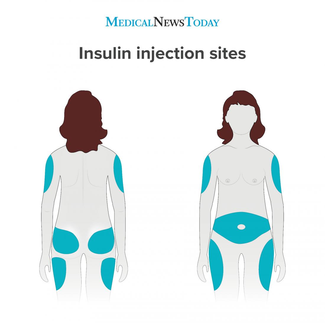 Best insulin injection sites: Absorption time and rotation