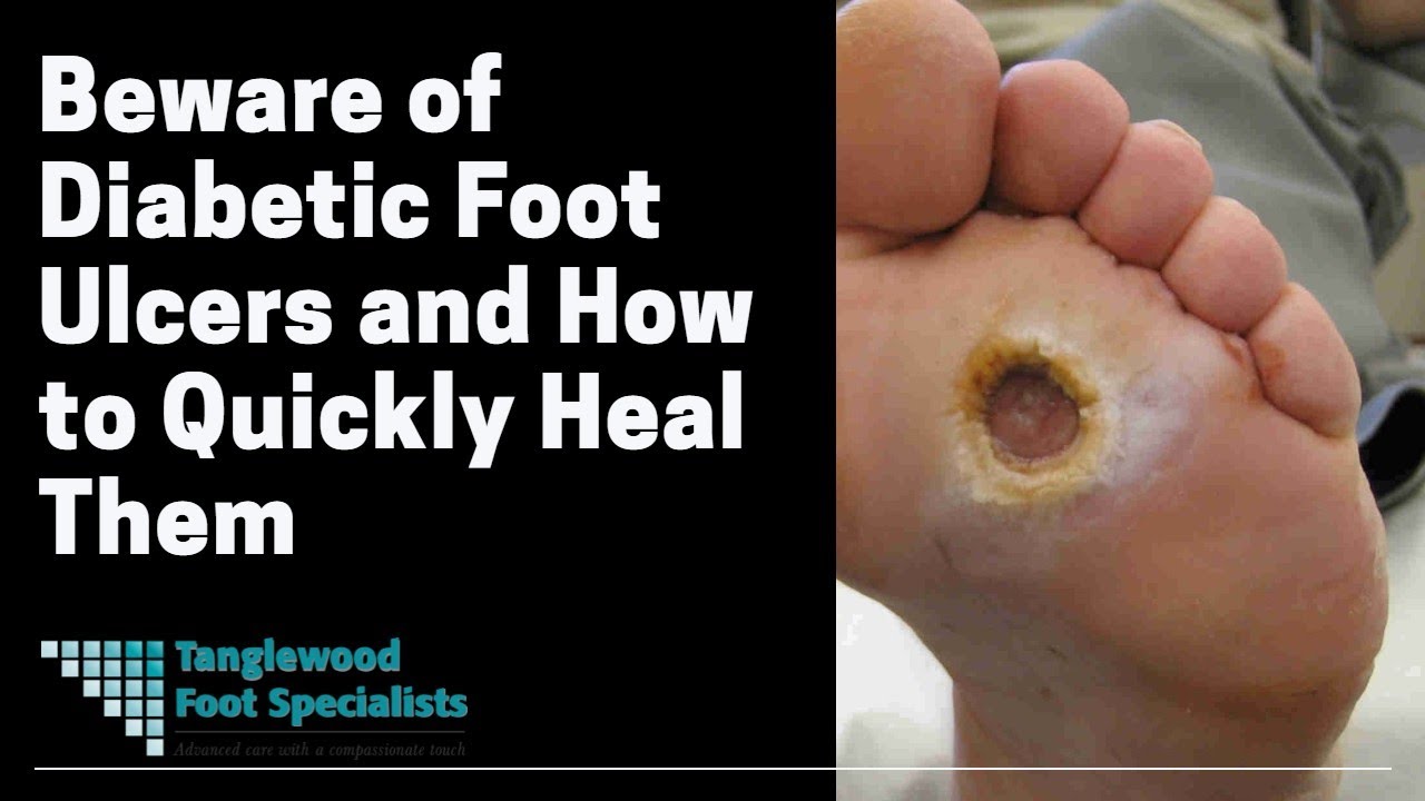 Beware of Diabetic Foot Ulcers and How to Quickly Heal ...