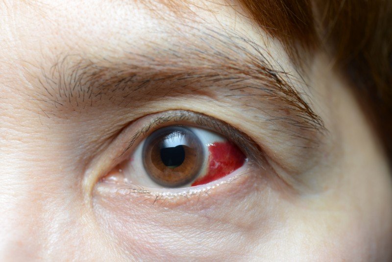 Blood Clot In Eye Due To Diabetes