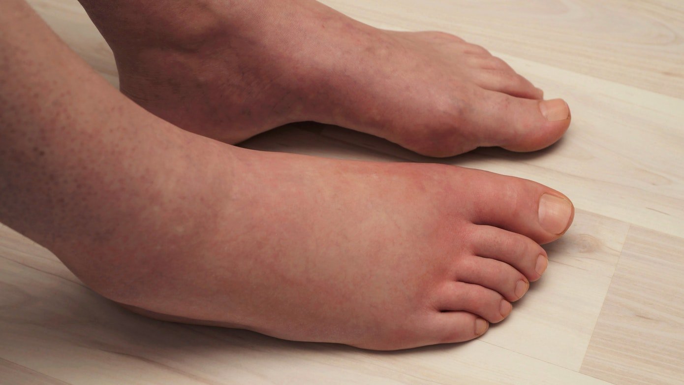 Causes Of Swollen Ankles In Diabetics