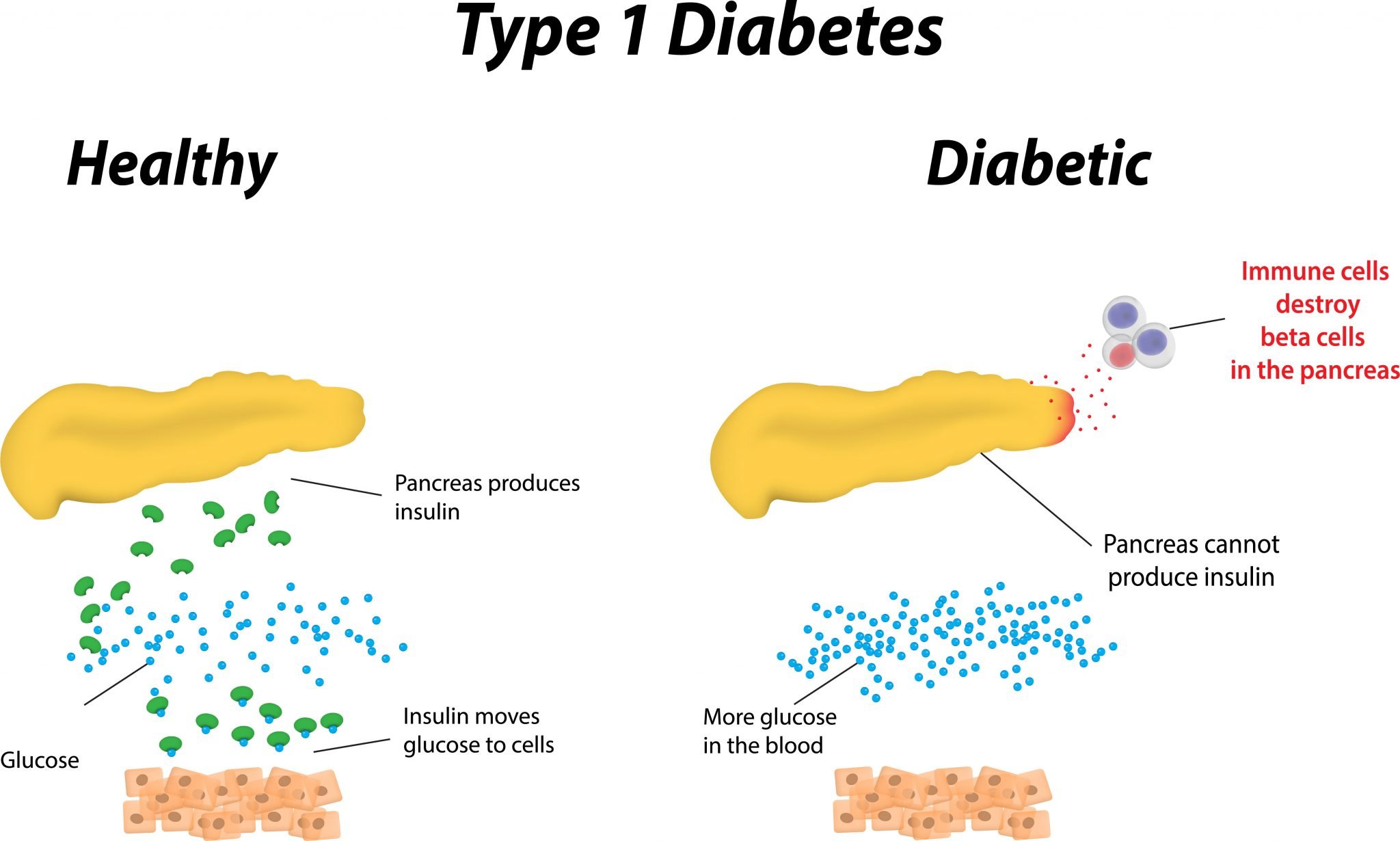 Causes of Type 1 Diabetes