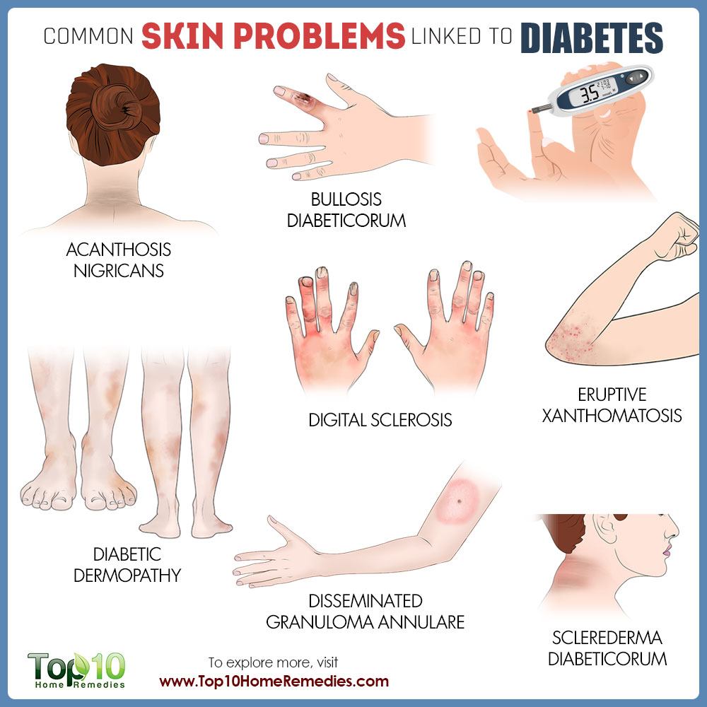 Common Skin Problems Linked to Diabetes