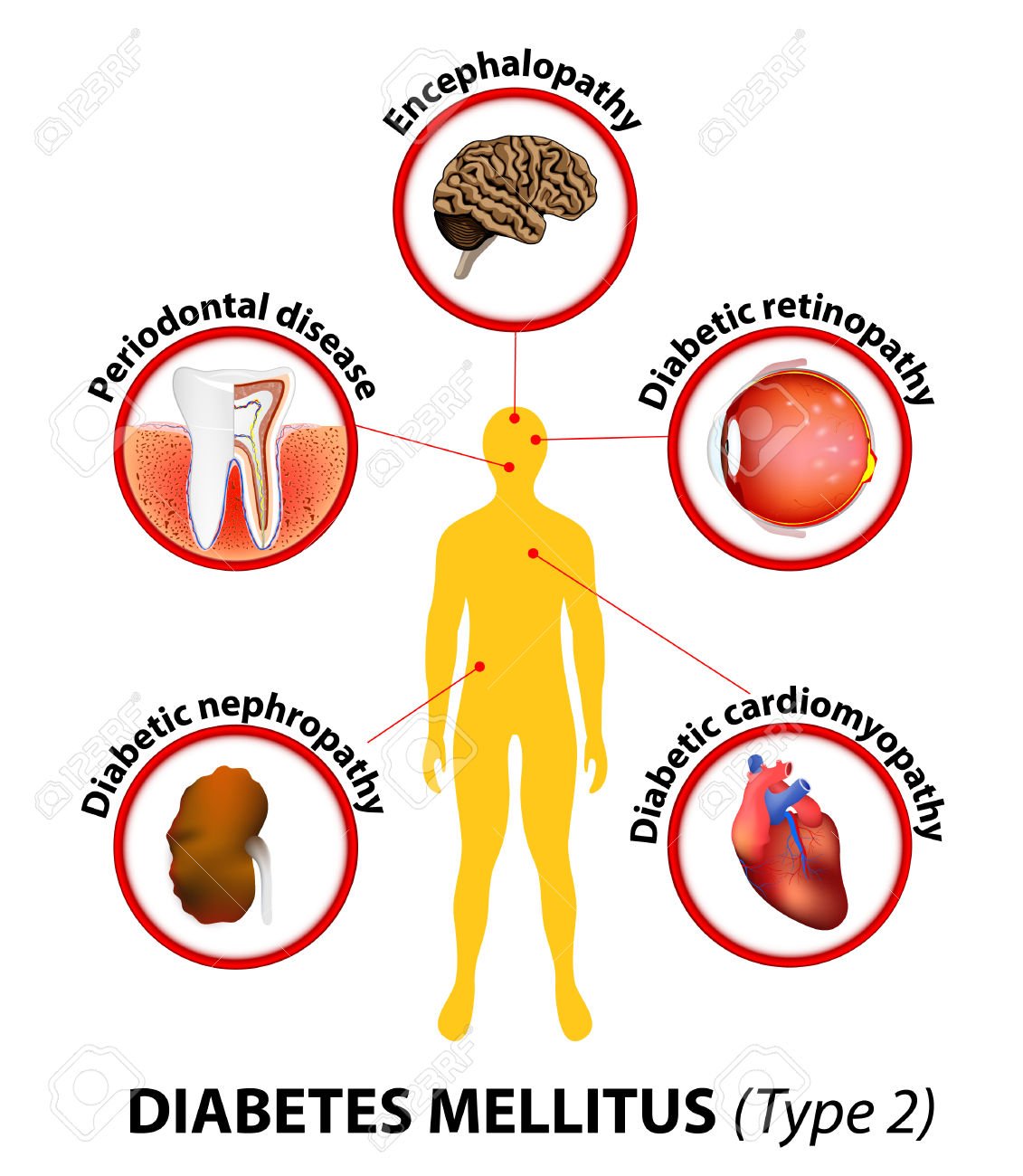 Diabetes Mellitus Type 2 Affected Organs Untreated ...