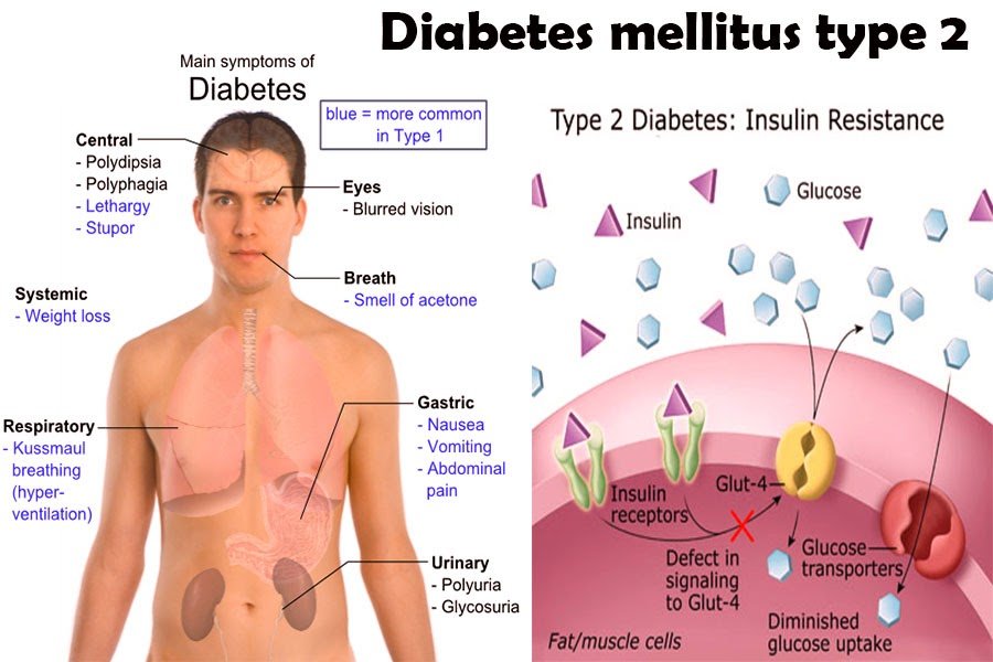 Diabetes Mellitus: What is the symptoms of Type 2 Diabetes mellitus?