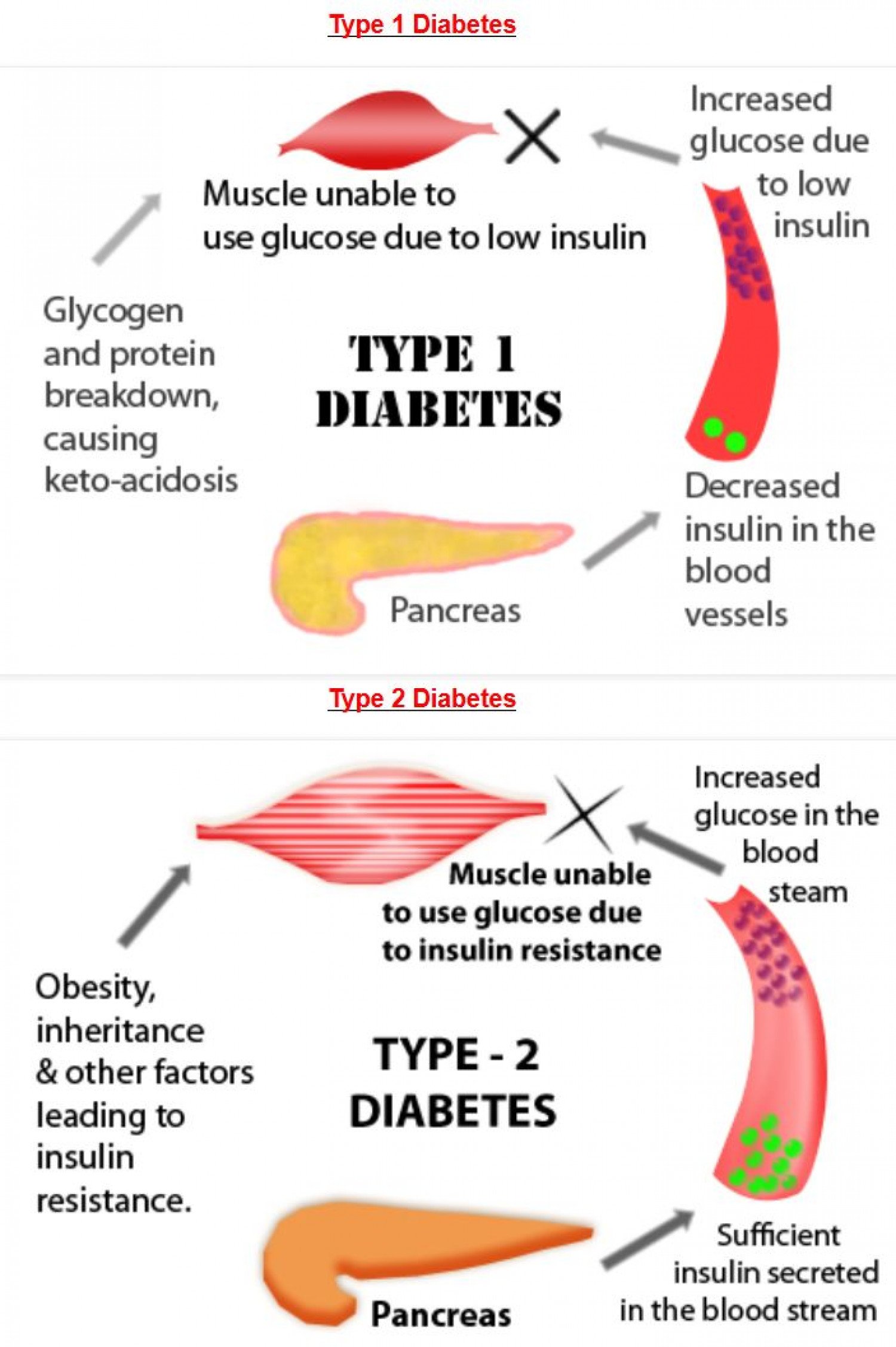 Diabetes: Type 1 Diabetes v/s Type 2 Diabetes