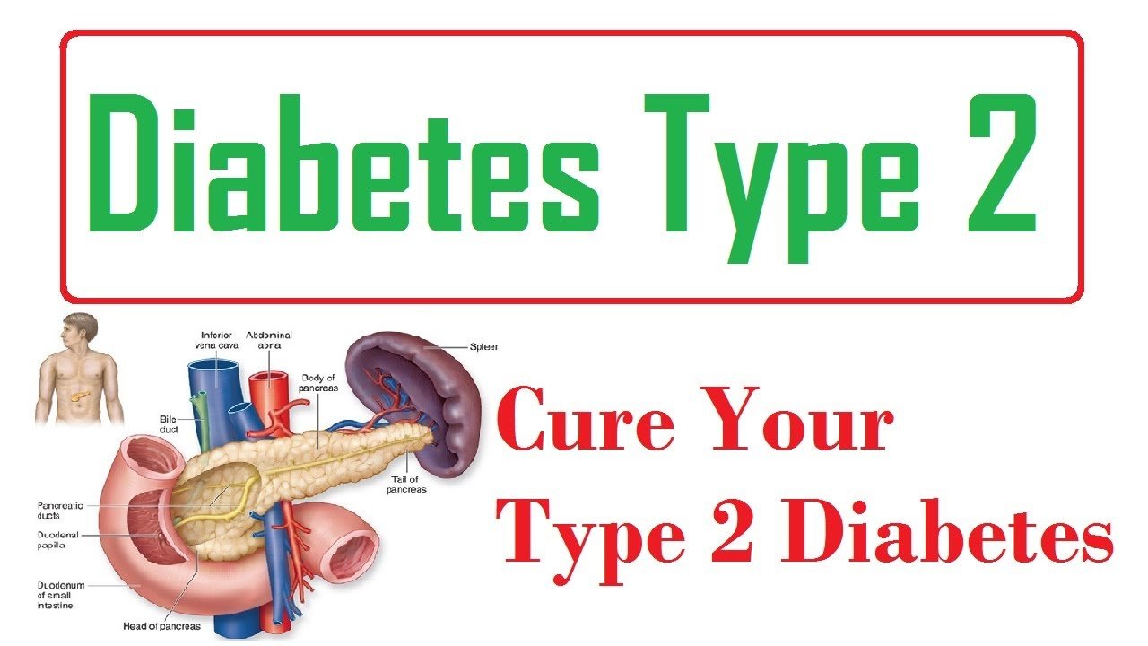 Diabetes Type 2 Permanent Cure