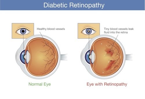 Diabetic eye disease: How to spot the signs early