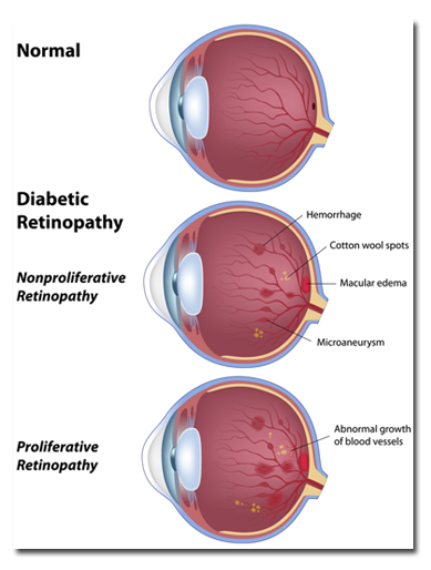 Diabetic Eye Disease &  Retinopathy Treatment in Sarasota ...