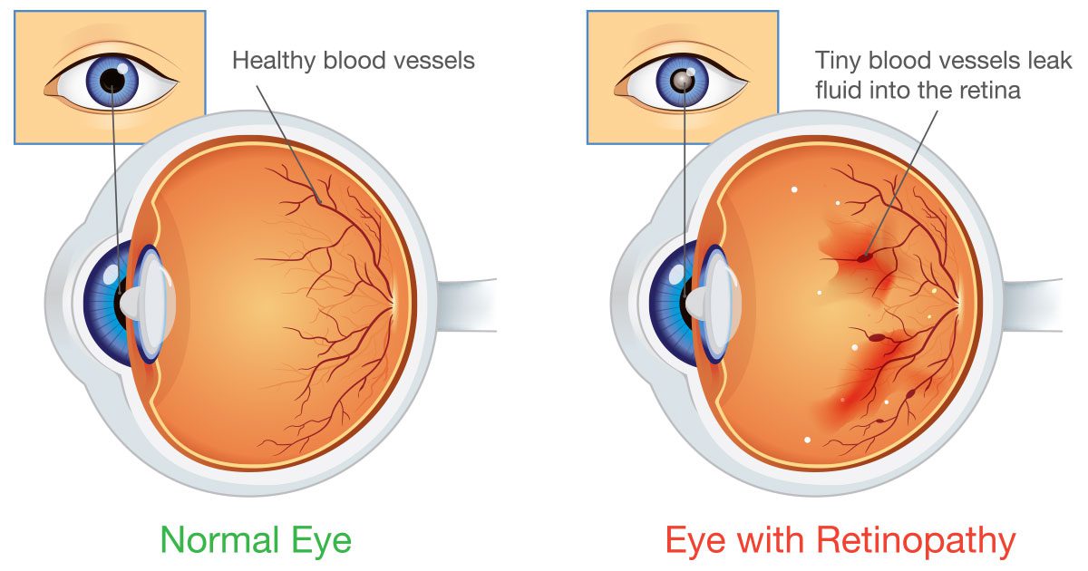 Diabetic Eye Disease: What You Need to Know