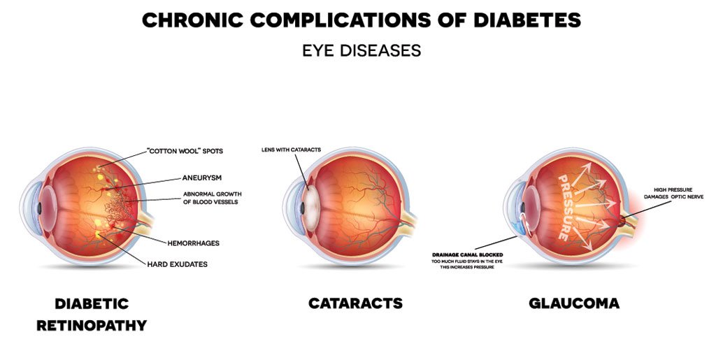 Diabetic Eye Problems