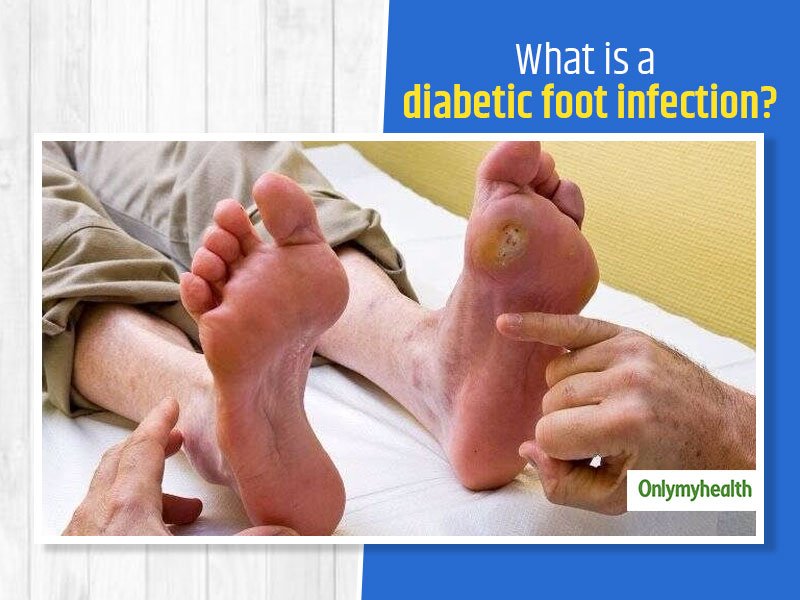 Diabetic Foot Infection: Symptoms, Risk Factors, Treatment ...