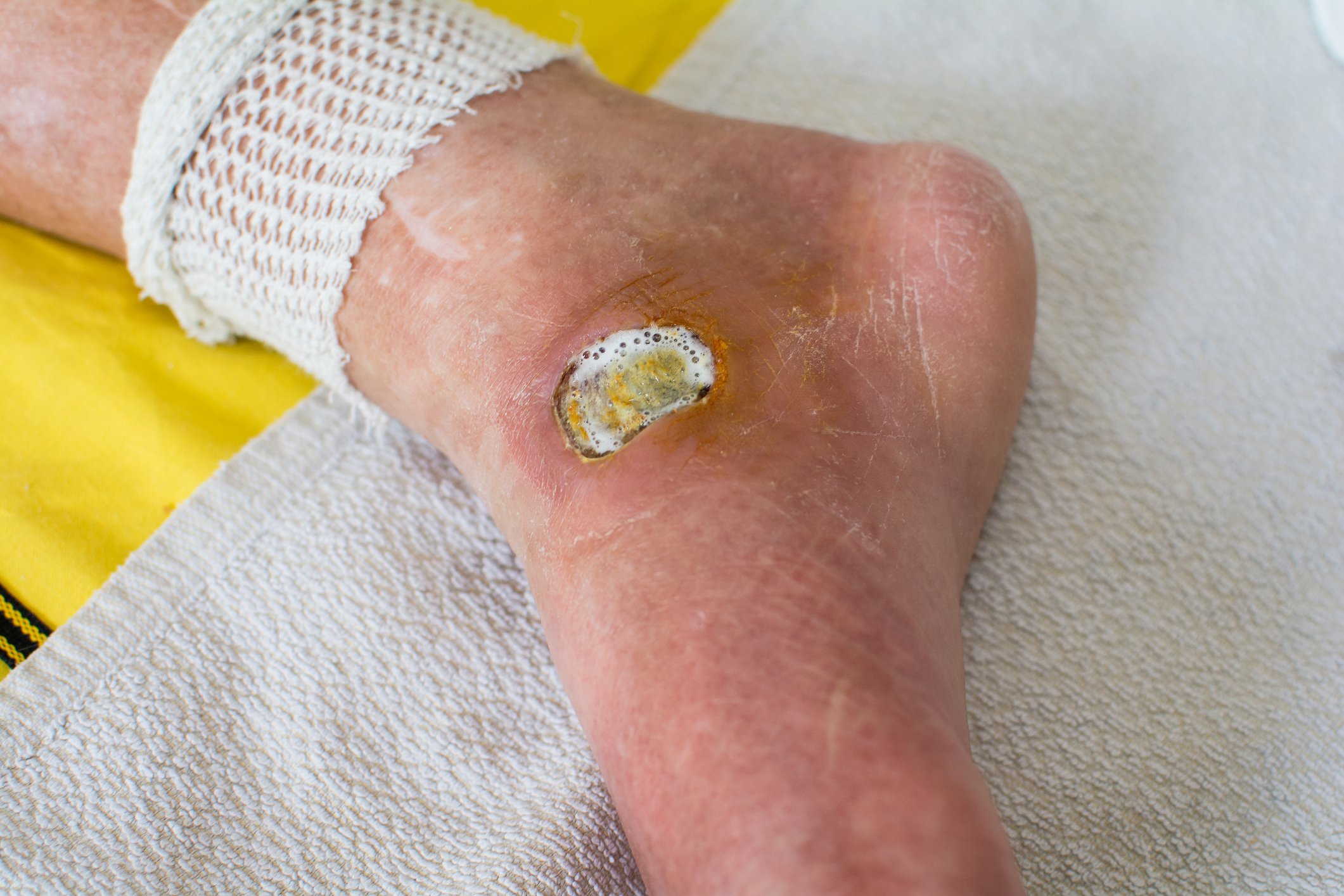Diabetic Foot Ulcers: Why You Should Never Ignore Them ...