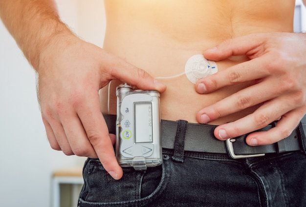 Diabetic man with an insulin pump connected in his abdomen and keeping ...
