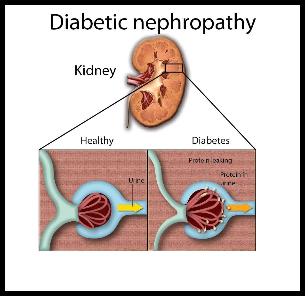 Diabetic Nephropathy and Urine