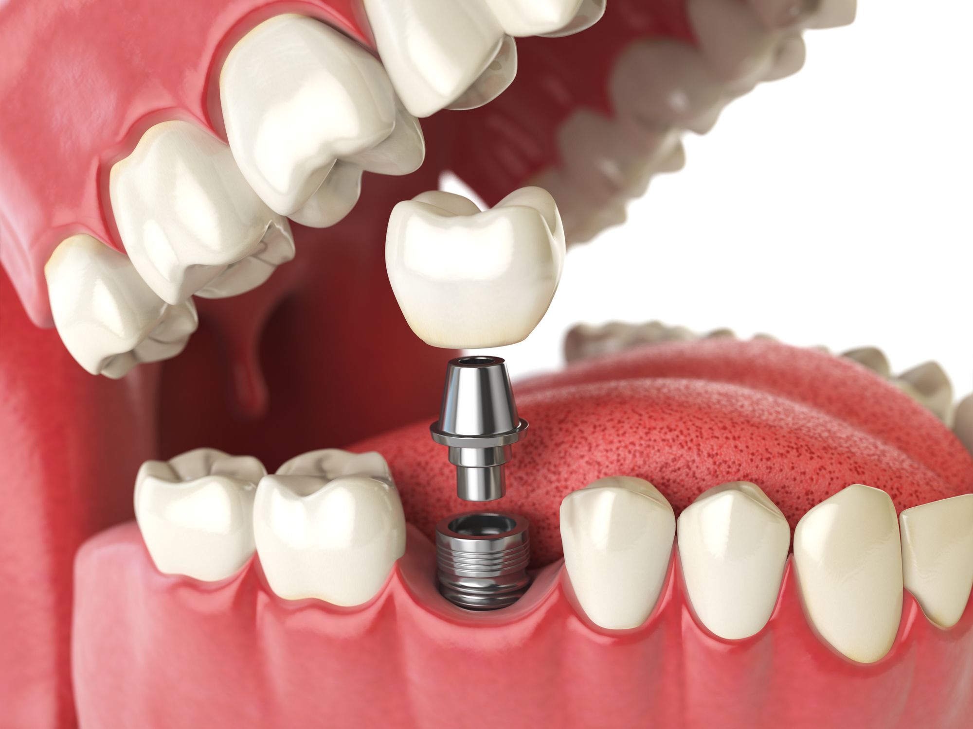 Diabetic Patients and Dental Implants