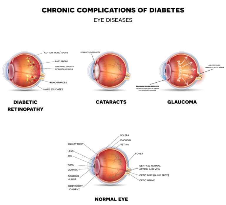 Diabetic Retinopathy â Florida Eye Associates