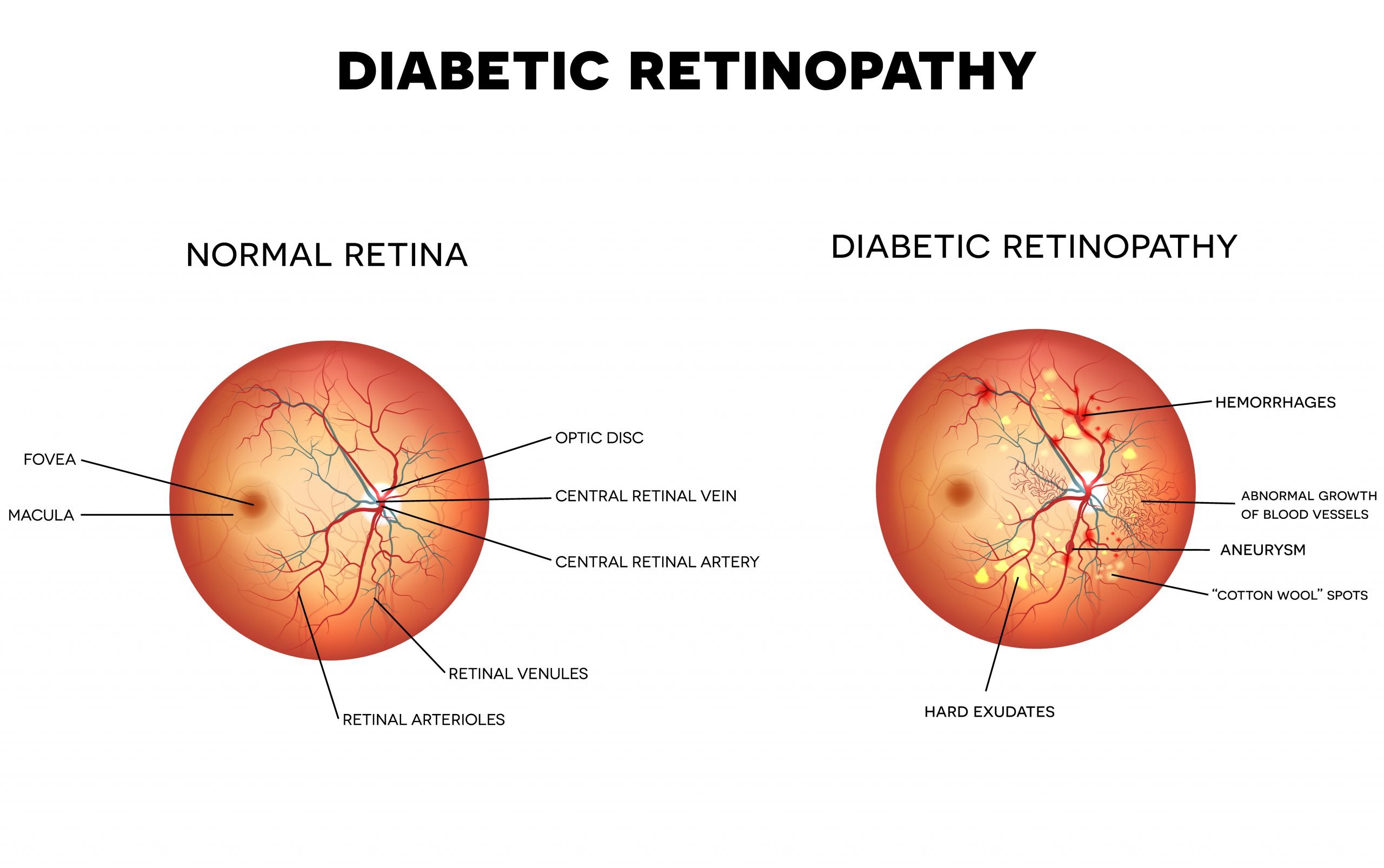 Diabetic Retinopathy :: Eye Health Central