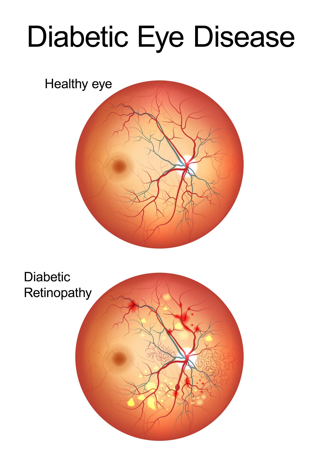Diabetic Retinopathy Stages