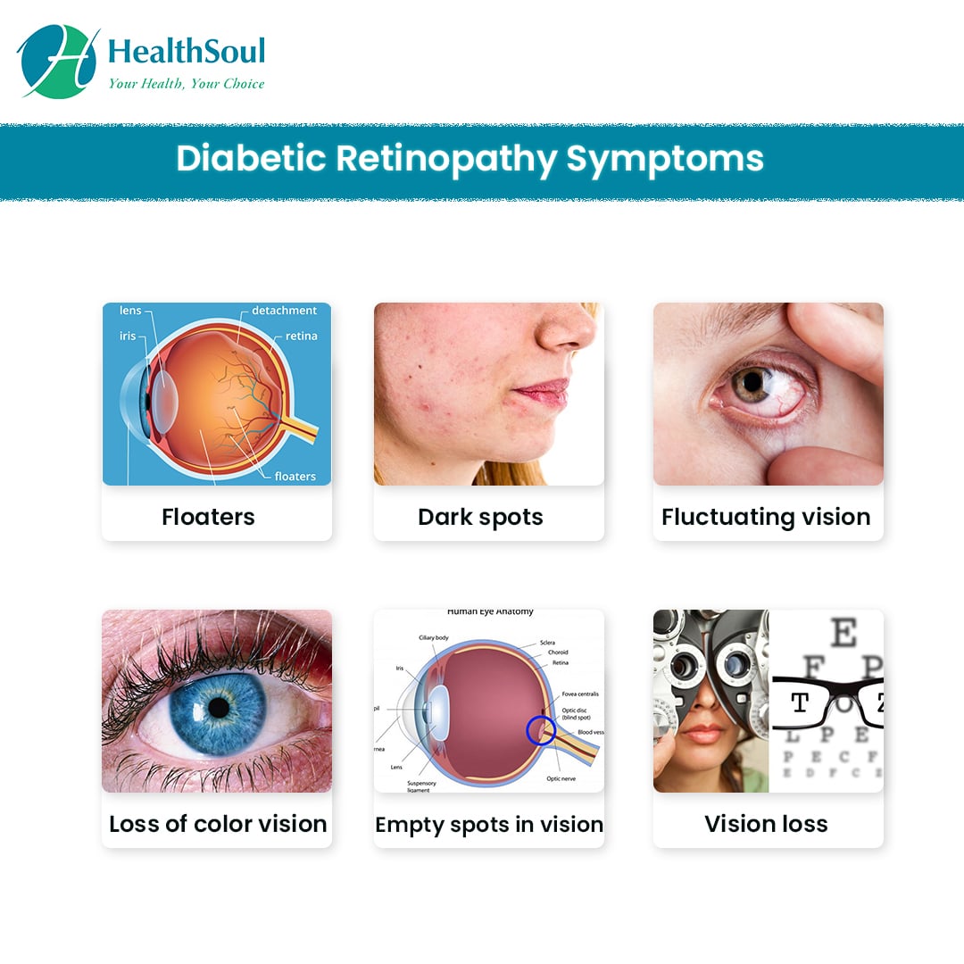 Diabetic Retinopathy: Symptoms, Diagnosis, and Treatment â Healthsoul