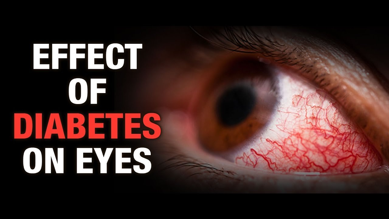 Effect of Diabetes on Eyes