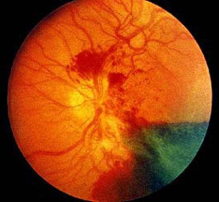 EYE CLINIC Diabetic retinopathy:Early detection and treatment