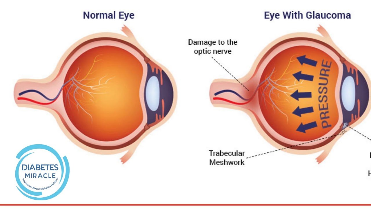 How Does Diabetes Affect Your Eyesight