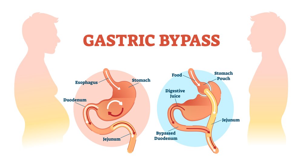 HOW DOES GASTRIC BYPASS SURGERY CURE TYPE 2 DIABETES ...