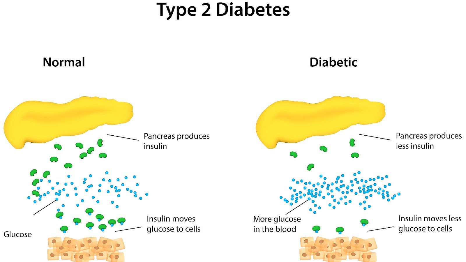 How Does Type 2 Diabetes Occur