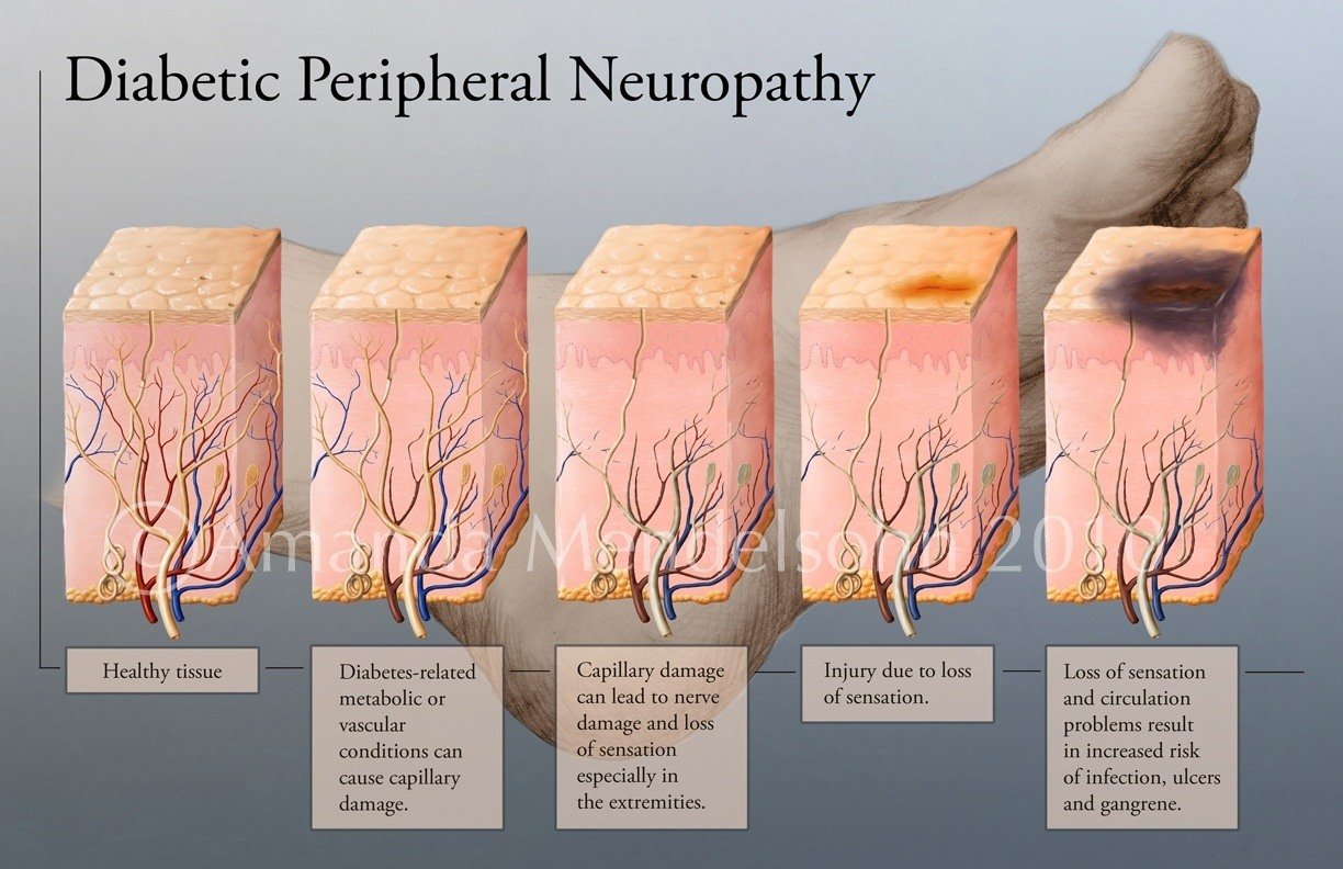 How to Recognize the 4 Types of Diabetic Neuropathy