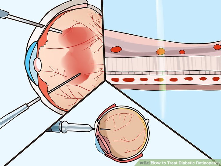How to Treat Diabetic Retinopathy: 8 Steps (with Pictures)