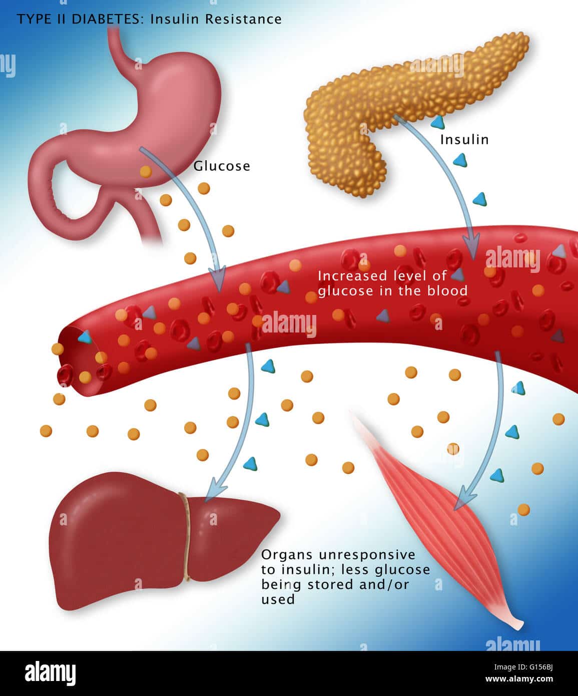 Illustration of insulin and glucose production in Type 2 diabetes Stock ...