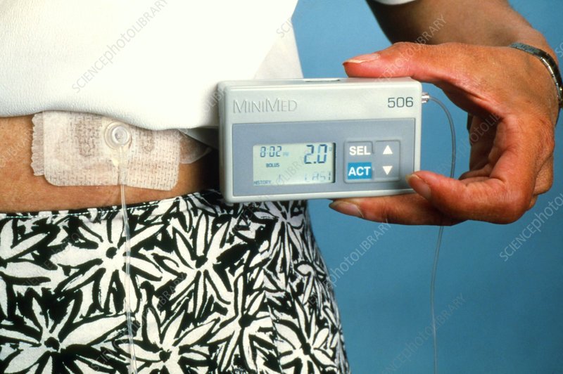 Insulin pump attached to a woman