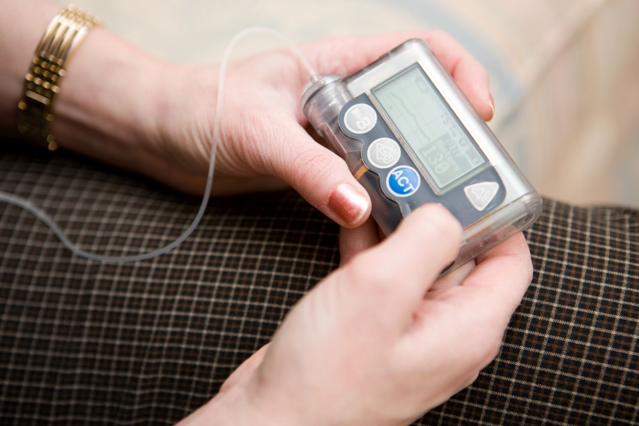 Insulin Pump Therapy for Type 2 Diabetes