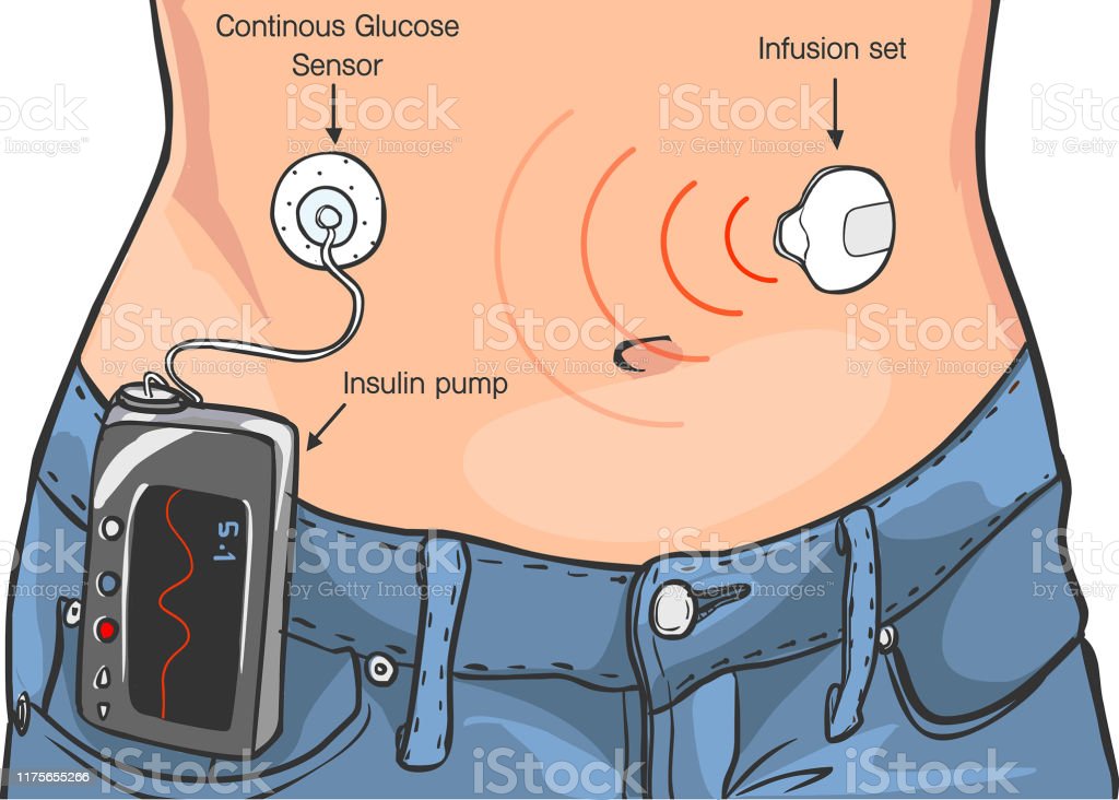 Insulin Pumps For Diabetes Patients Vector llustration Stock ...