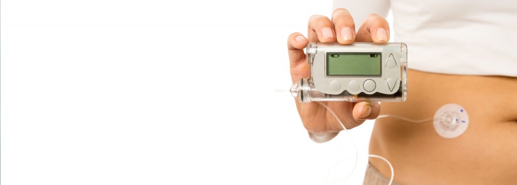 Insulin Pumps for Type 2 Diabetes