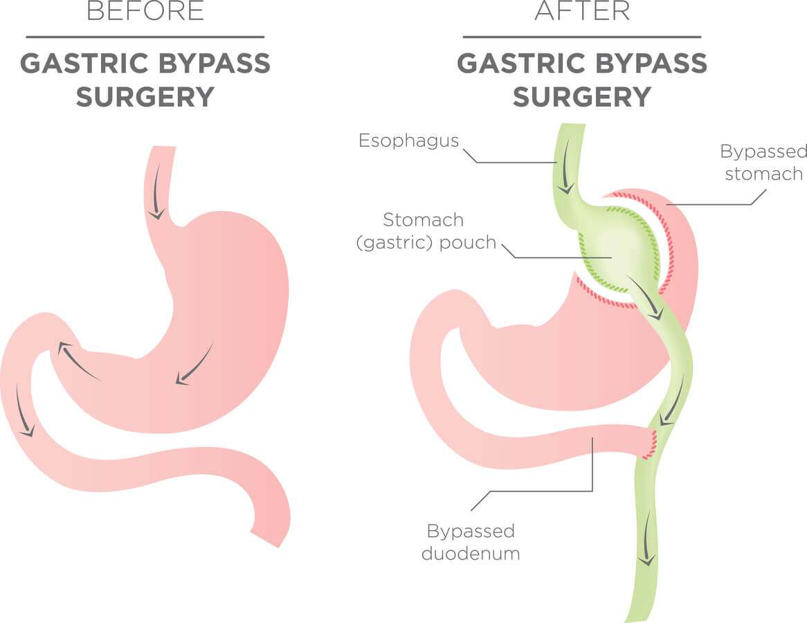 Is Gastric Bypass Surgery Your Best Choice For Reversing Diabetes?