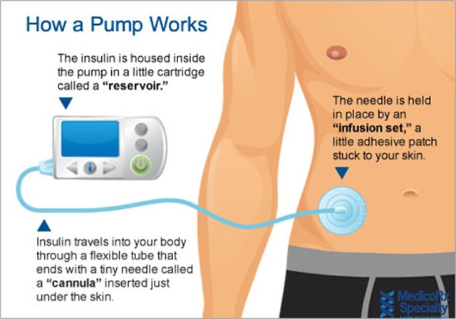 Is Insulin Pump Therapy Right For You?