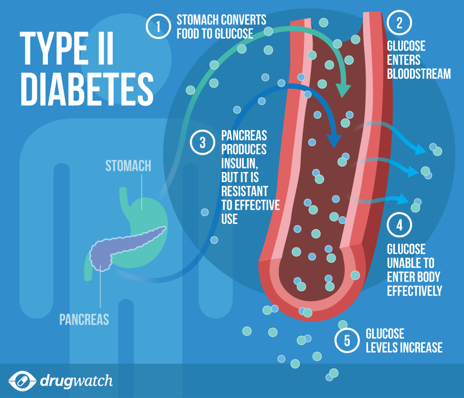 Is Type 2 Diabetes Curable? (8 Things You Should Know)