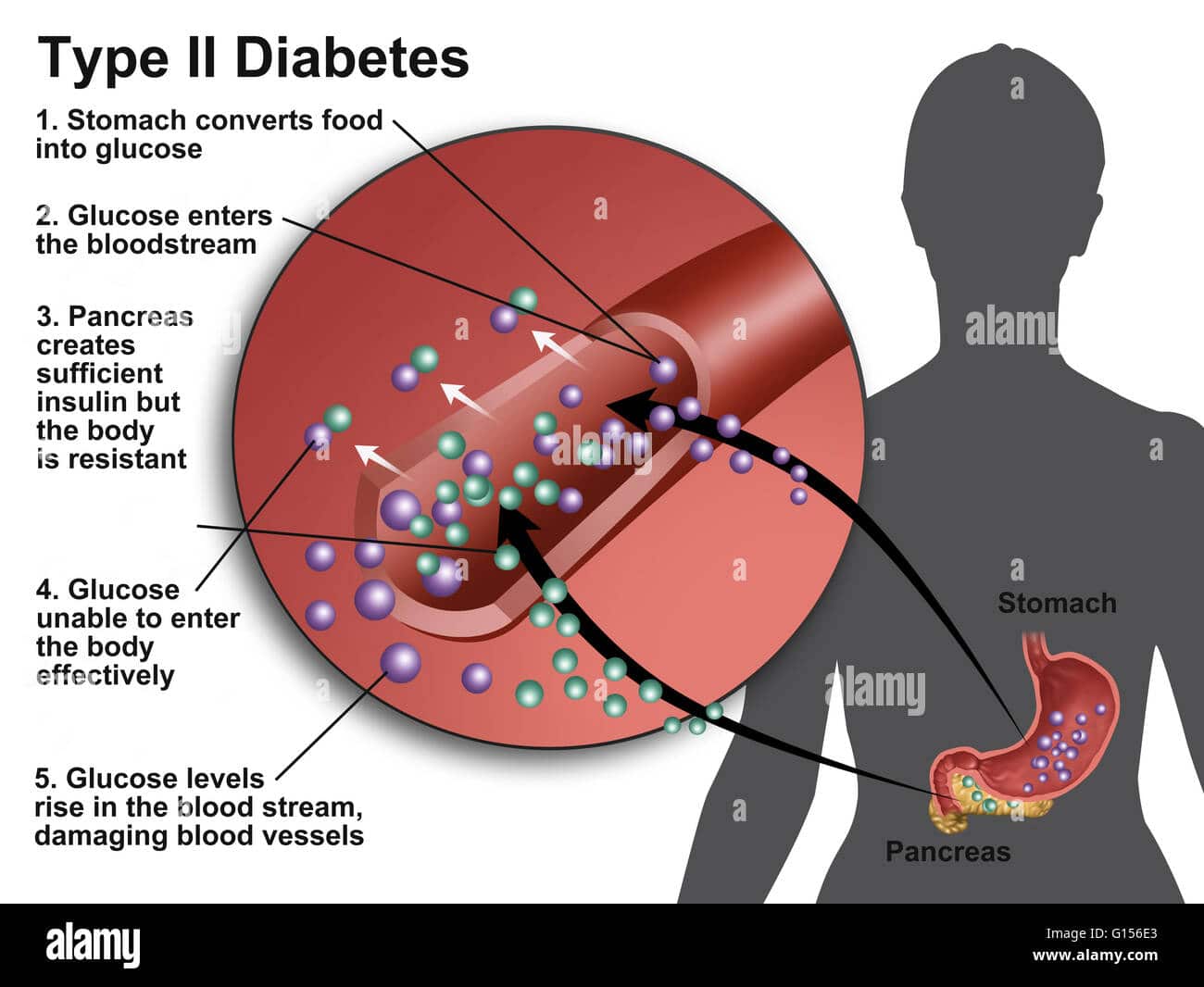 llustration of insulin and glucose production in Type 2 diabetes Stock ...