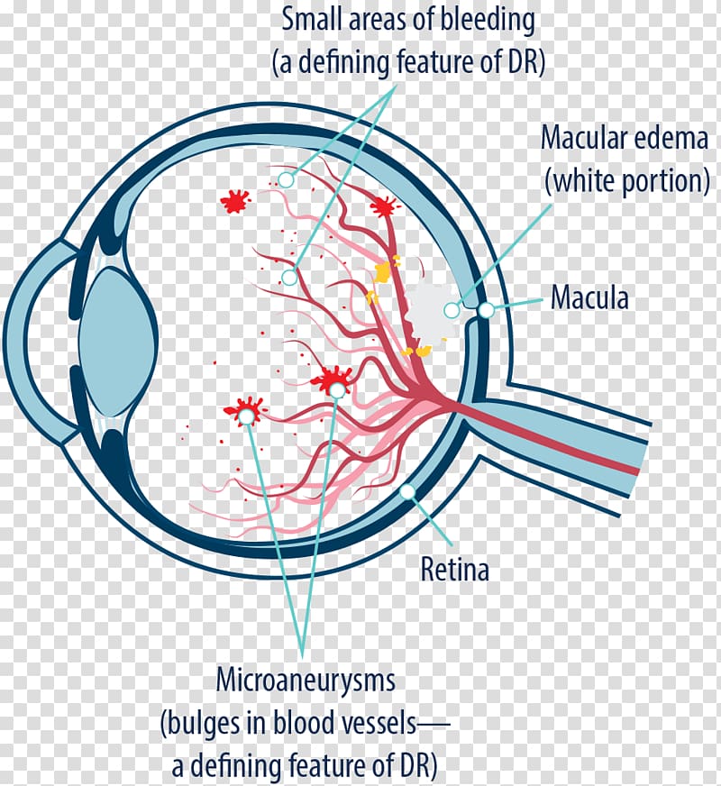 Macular edema Diabetic retinopathy Macula of retina Macular ...