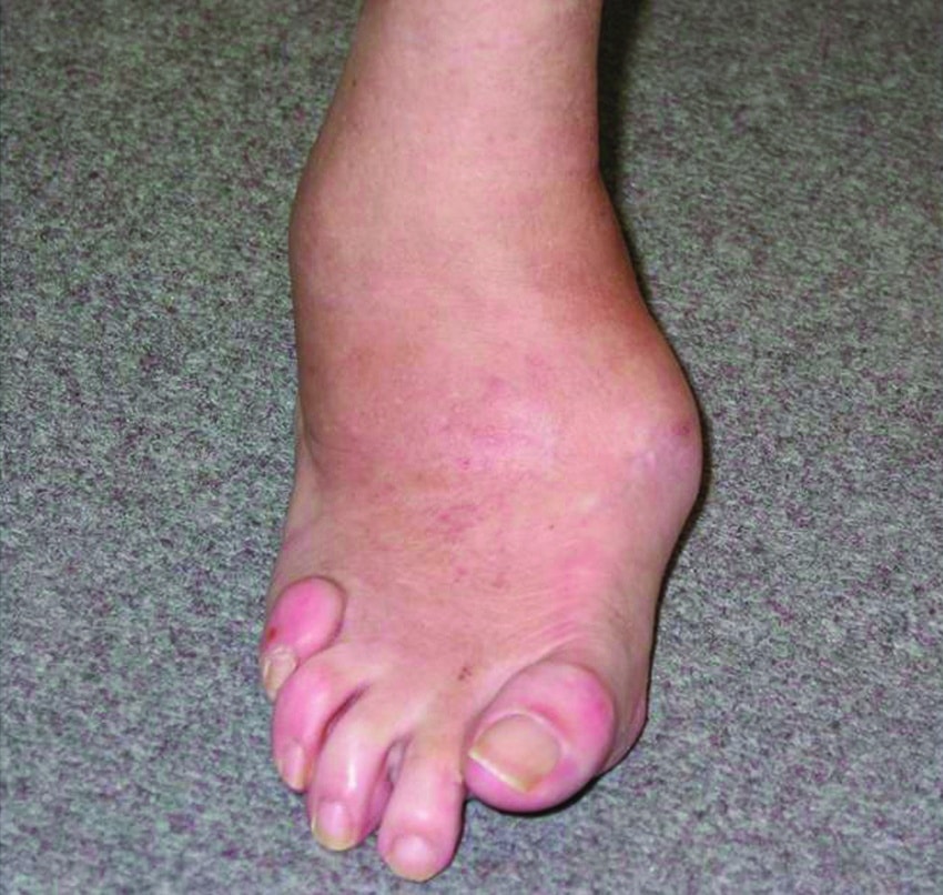 Managing complications of the diabetic foot