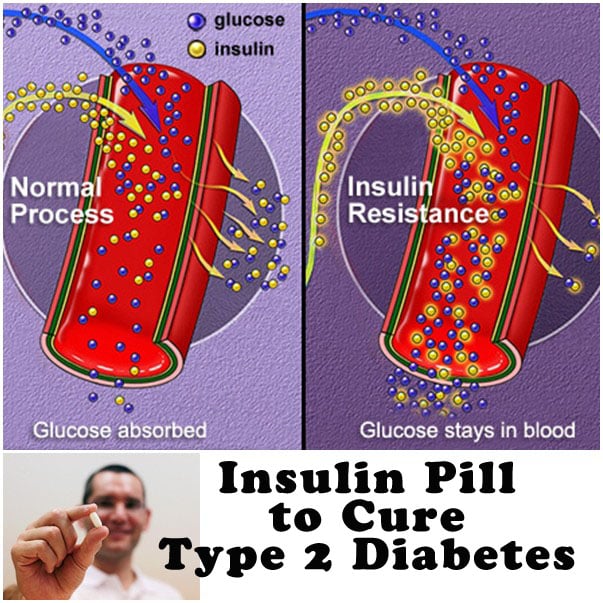 New Oral Insulin Pill to Cure Type 2 Diabetes