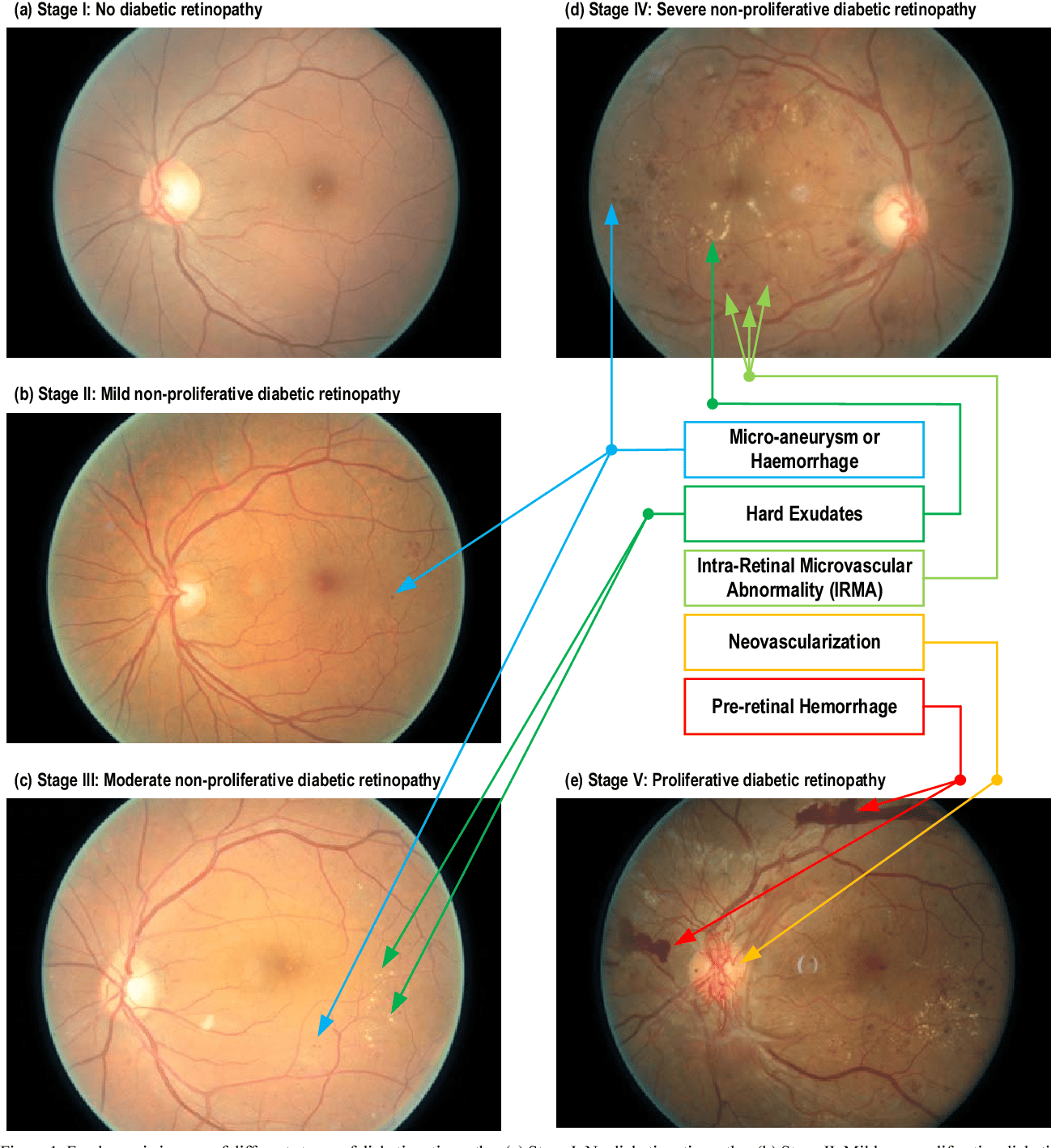 Non Proliferative Diabetic Retinopathy Stages