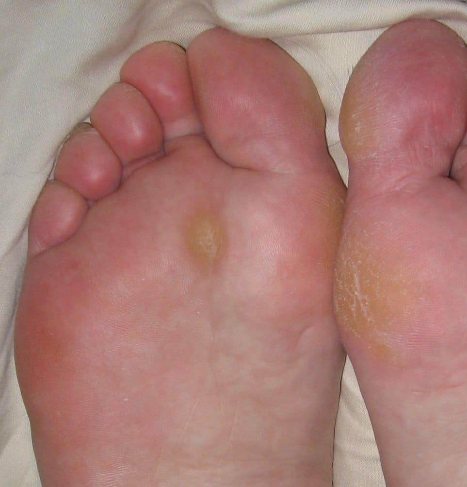 Painful White Spot On Bottom Of Foot