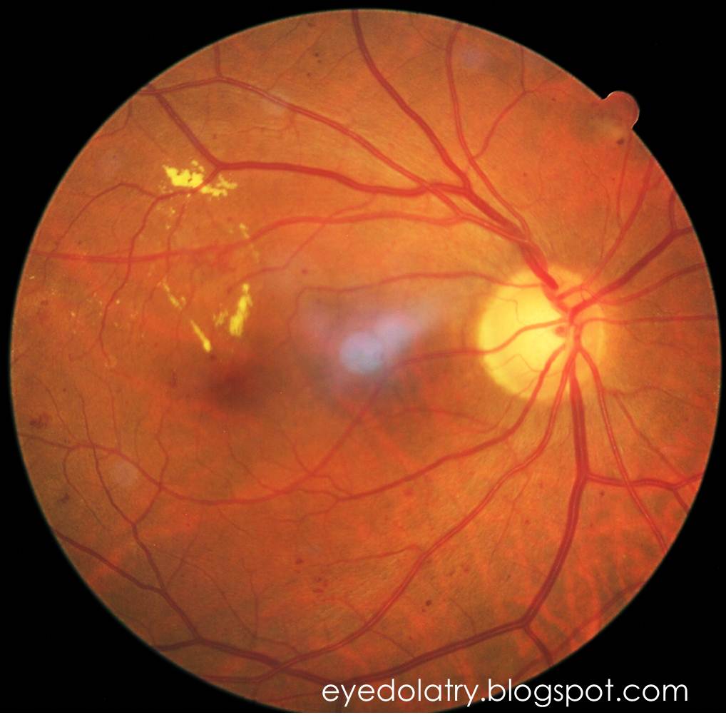 Picture Review of Diabetic Retinopathy