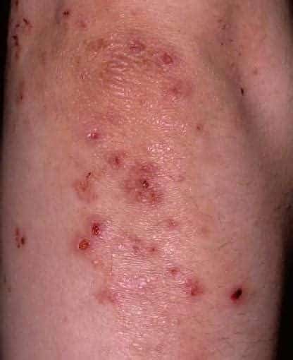 Pictures of skin rashes on lower legs, a skin rash on one lower