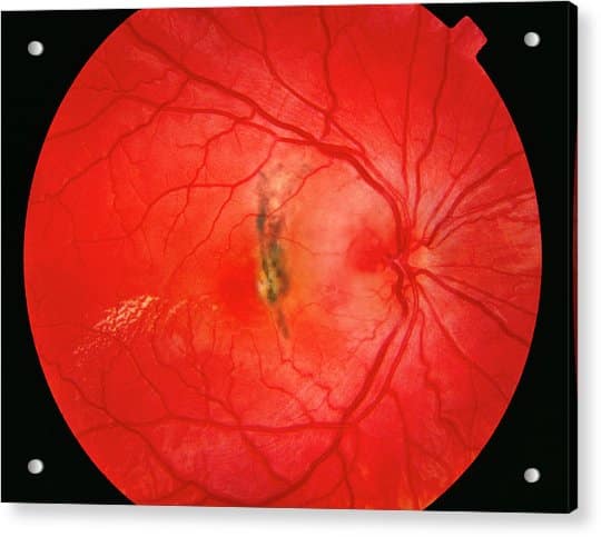 Retina Damage From Diabetes Photograph by Sue Ford/science Photo Library